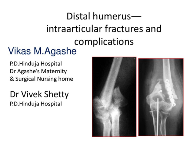 Distal Humerus Intraarticular Fractures and Complications